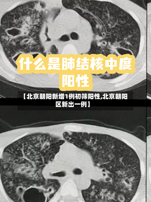 【北京朝阳新增1例初筛阳性,北京朝阳区新出一例】-第2张图片